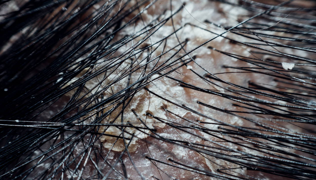 9. Fights Scalp Infections: