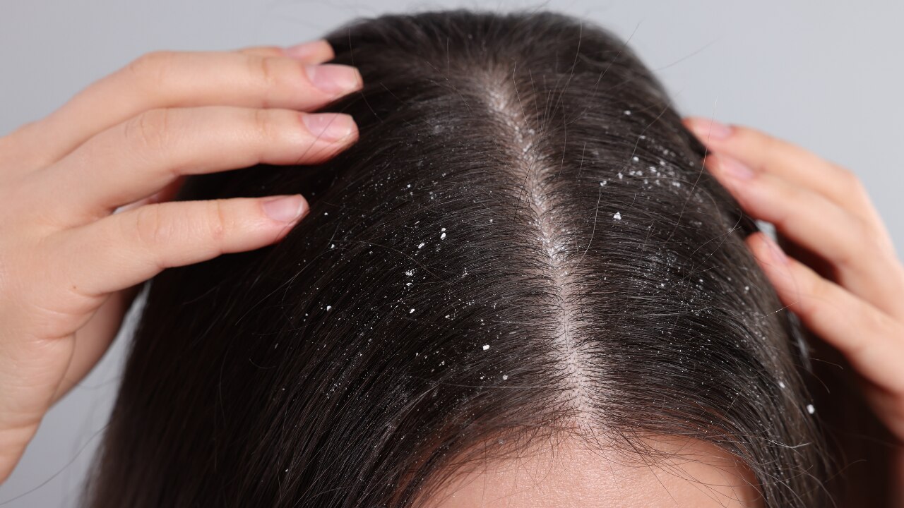 4. Dandruff Control: