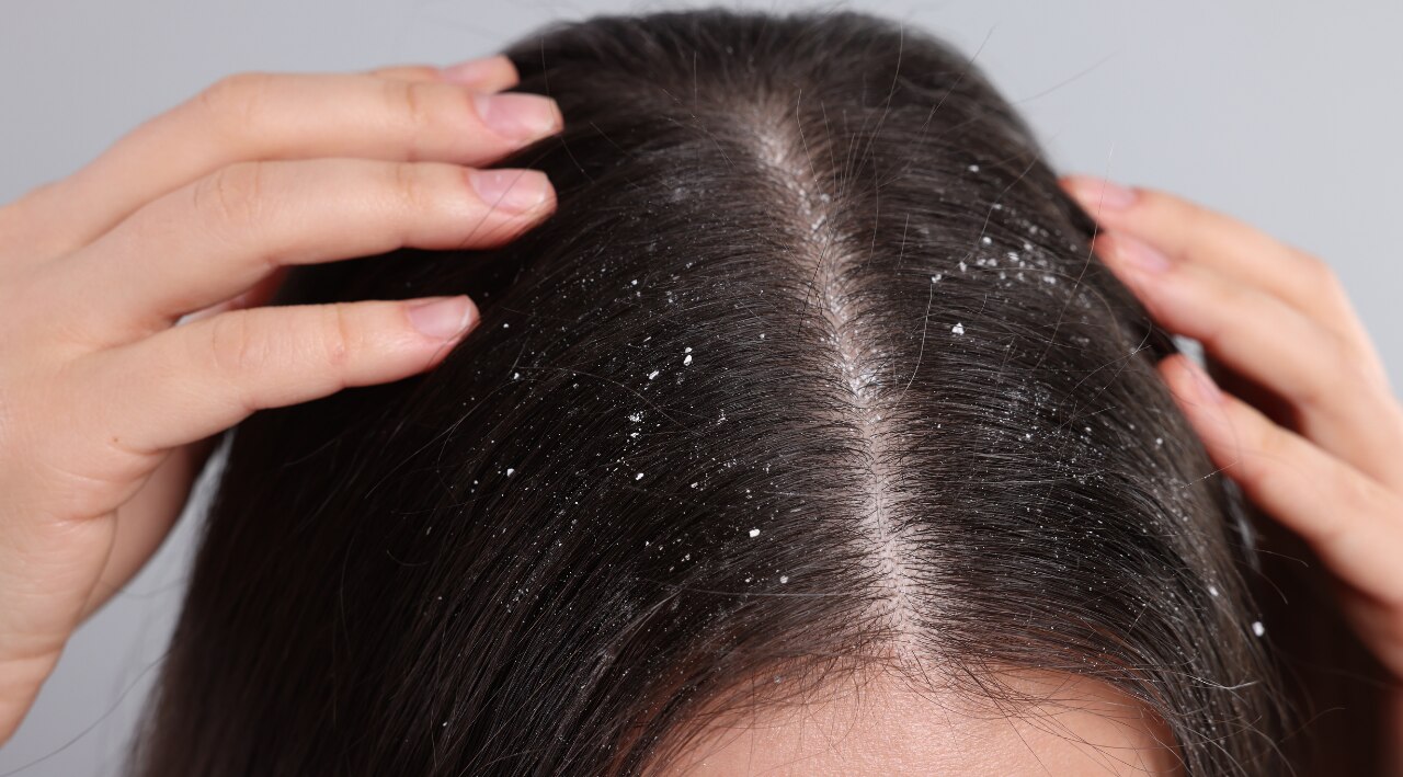 4. Dandruff Control: