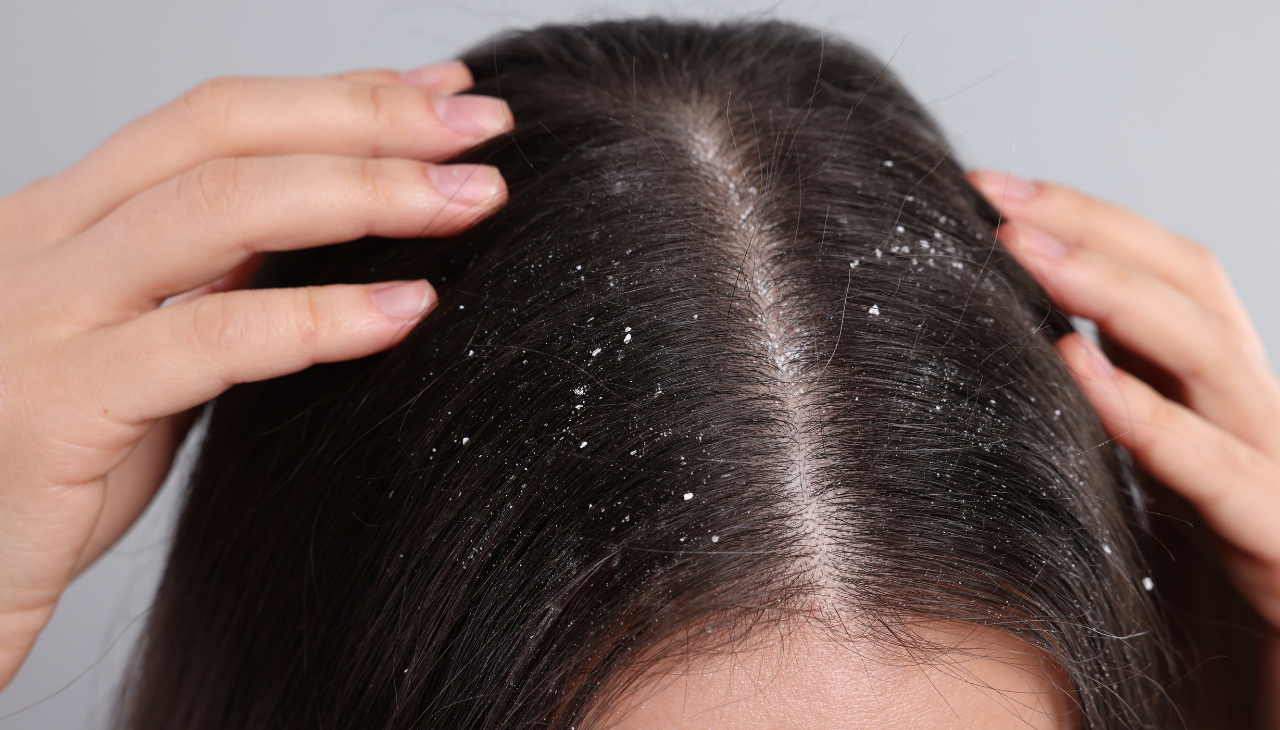 4. Dandruff Control: