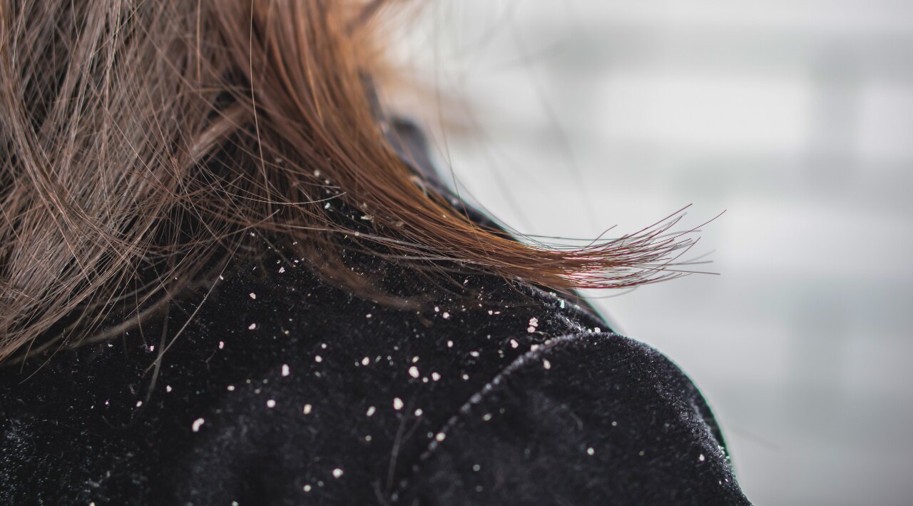 4. Aloe Vera and Lemon Juice (For Oily/Stubborn Dandruff)