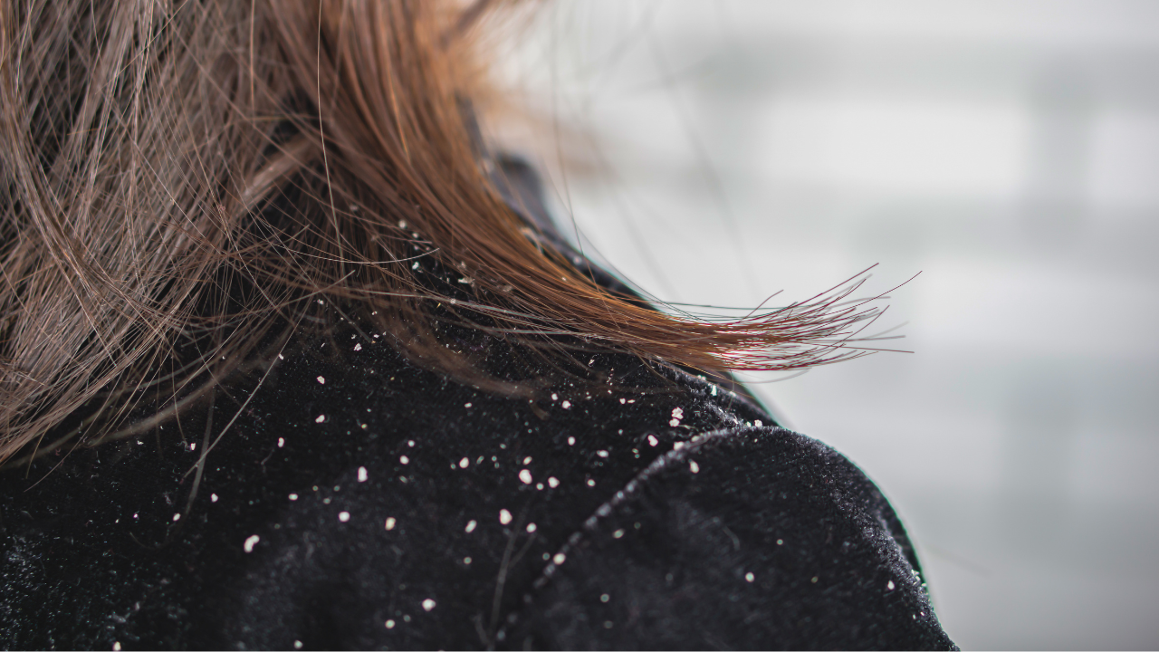 4. Aloe Vera and Lemon Juice (For Oily/Stubborn Dandruff)