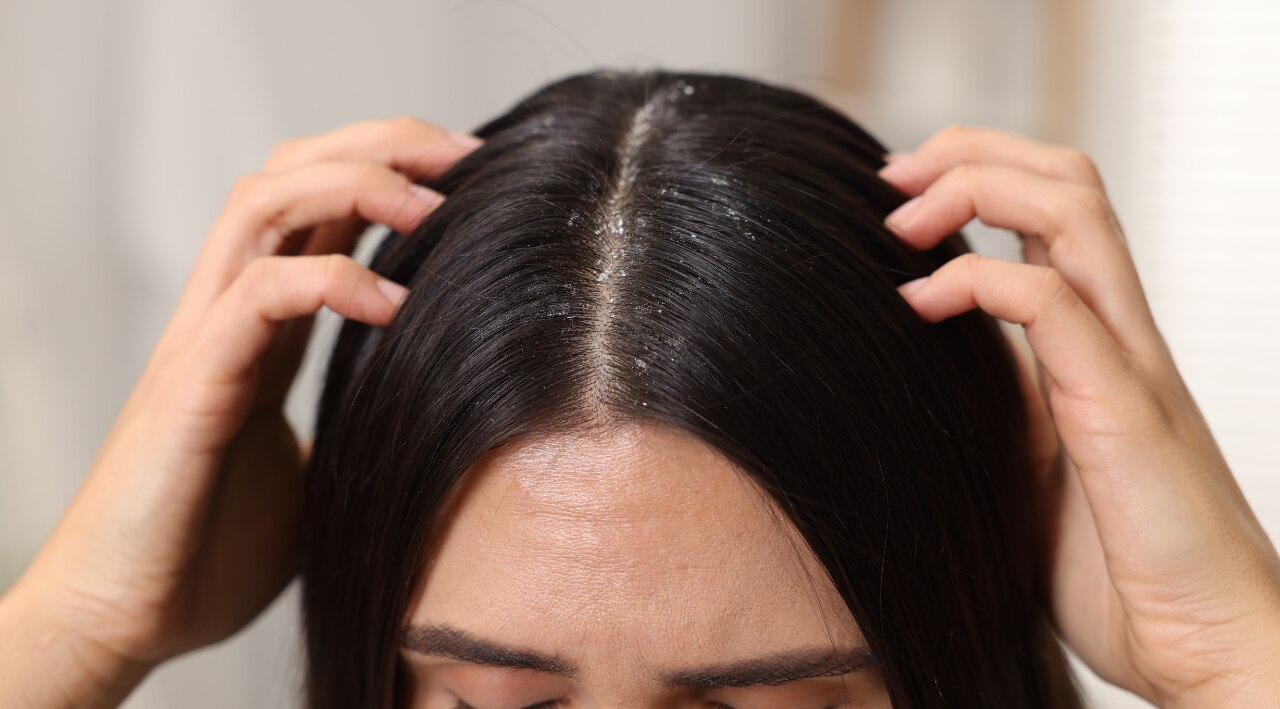 Benefits of Tea Tree Oil for Dandruff