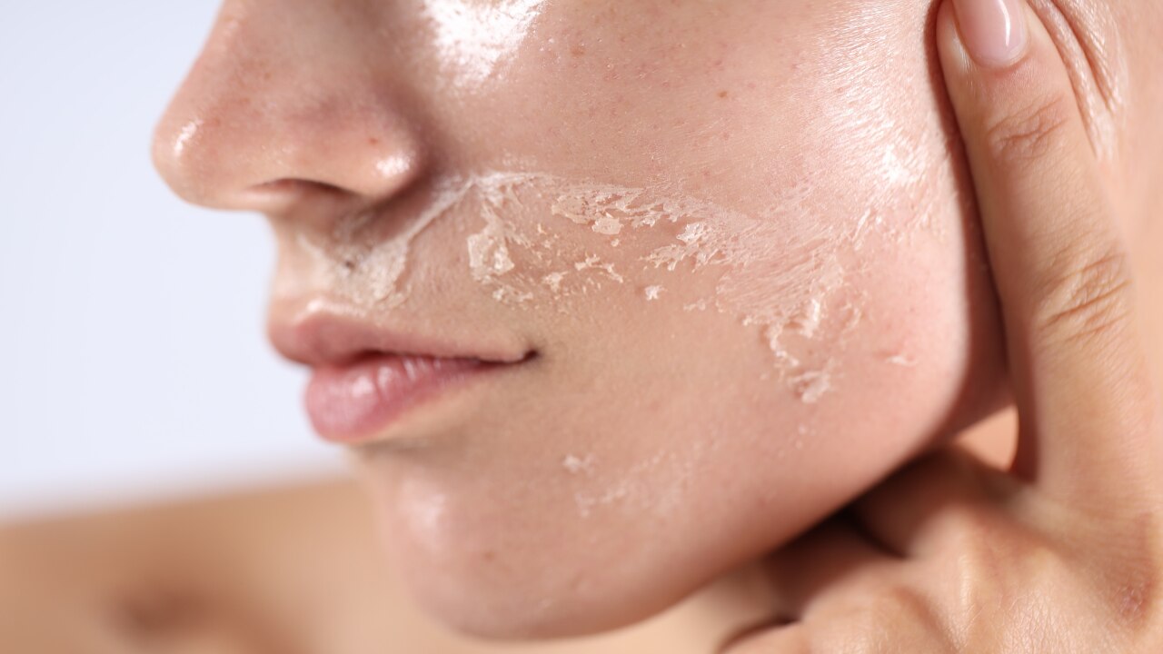 Side Effects of Apple Cider Vinegar on Face