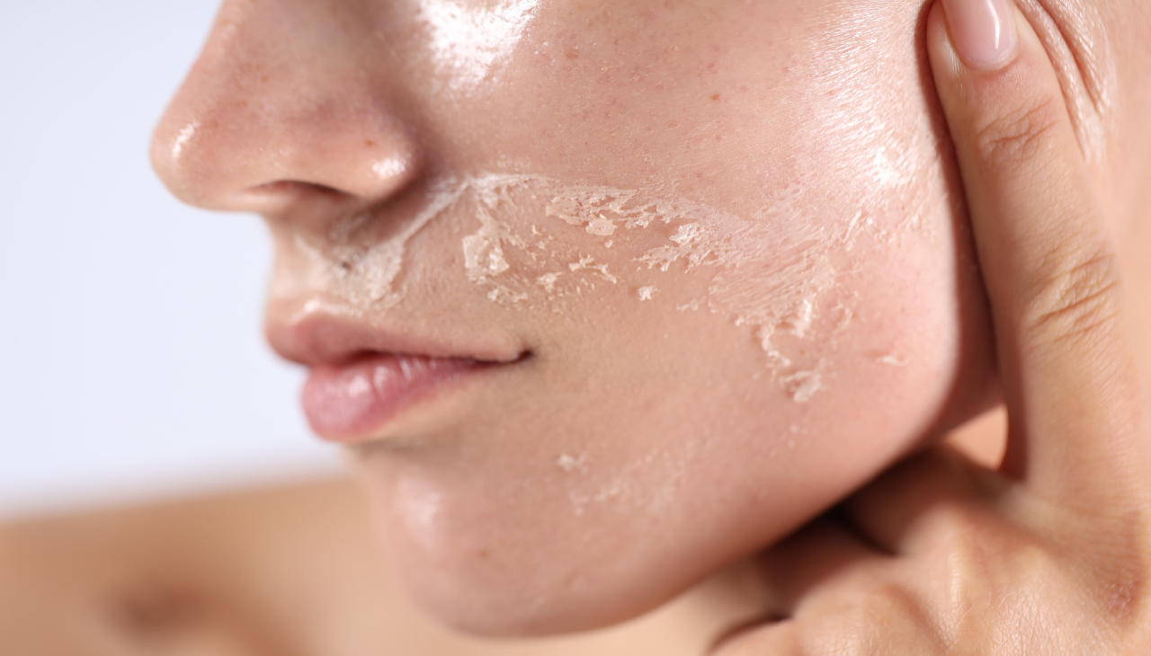 Side Effects of Apple Cider Vinegar on Face