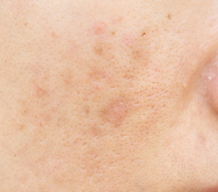 Image of How to Remove Dark Spots on Face Naturally: Causes, Types & Home Remedies