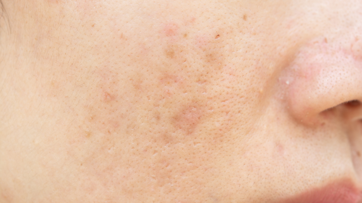How to Remove Dark Spots on Face Naturally with Home Remedies