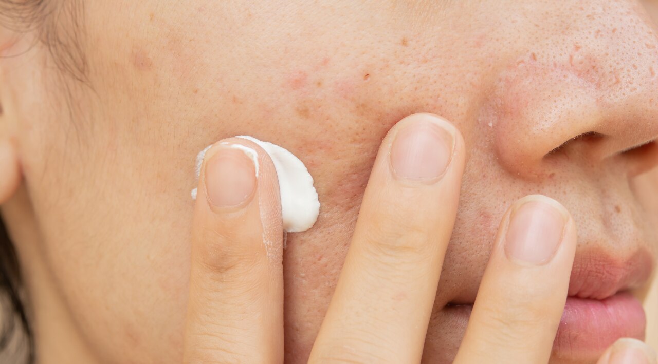 Mistakes That Worsen Dark Spots