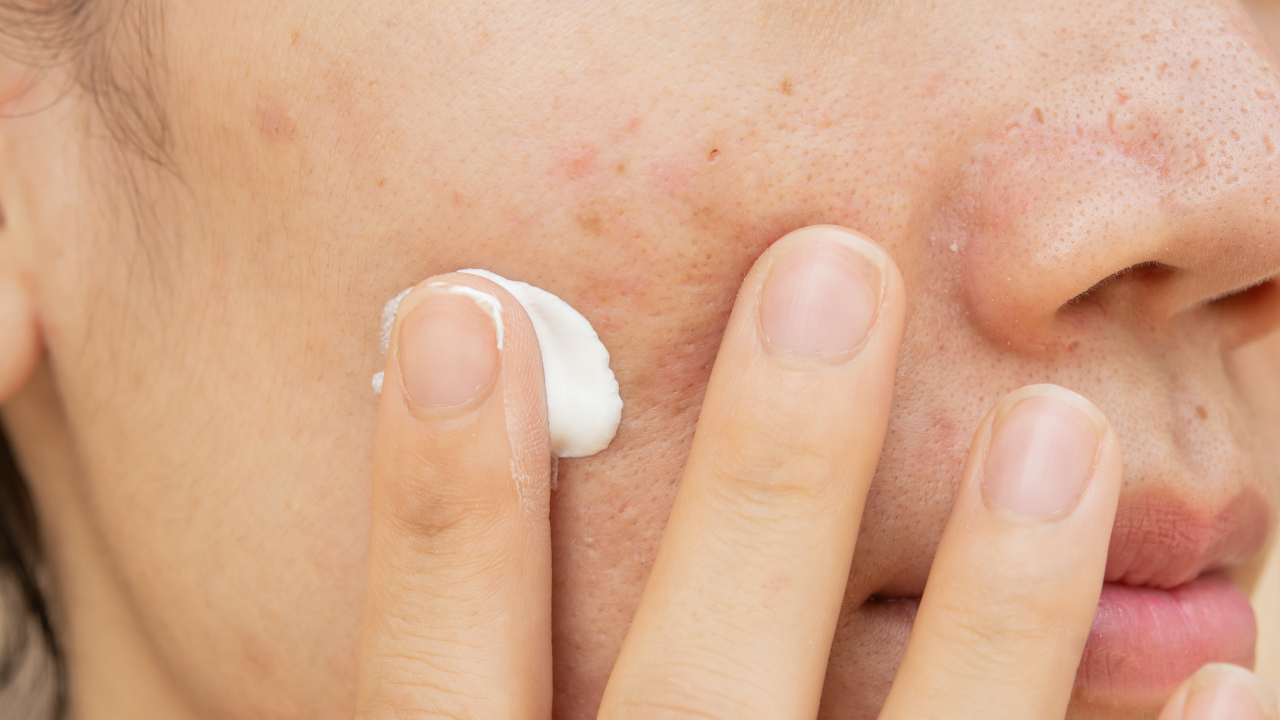 Mistakes That Worsen Dark Spots