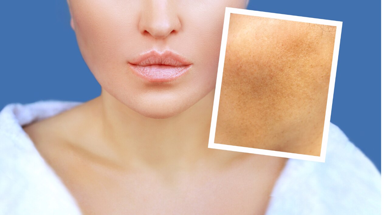 Identifying the Types of Dark Spots on Face