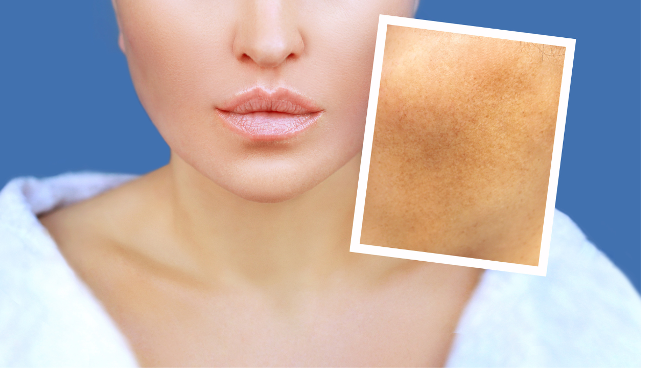 Identifying the Types of Dark Spots on Face