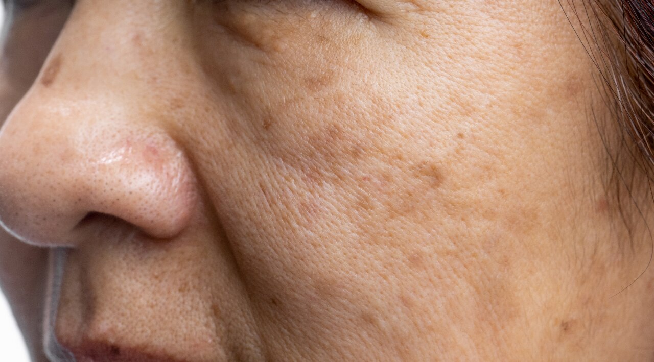 What Causes Dark Spots on Face?