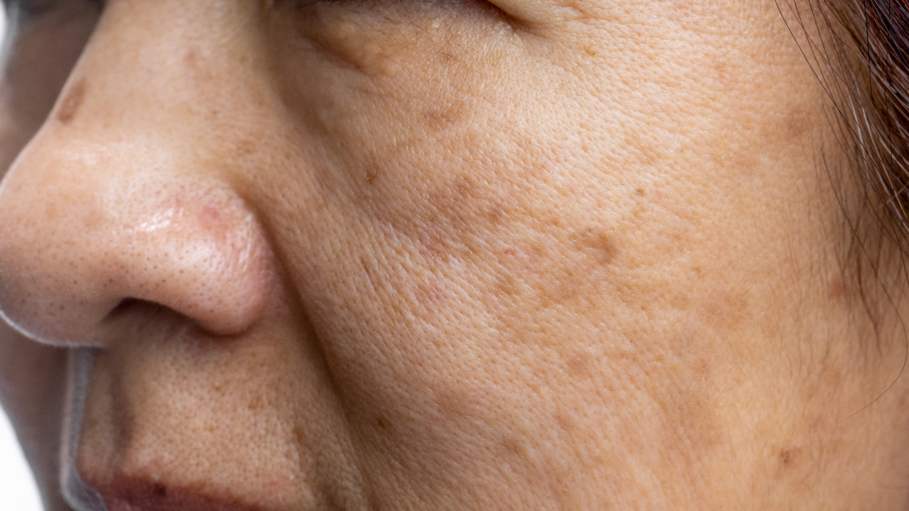 What Causes Dark Spots on Face?