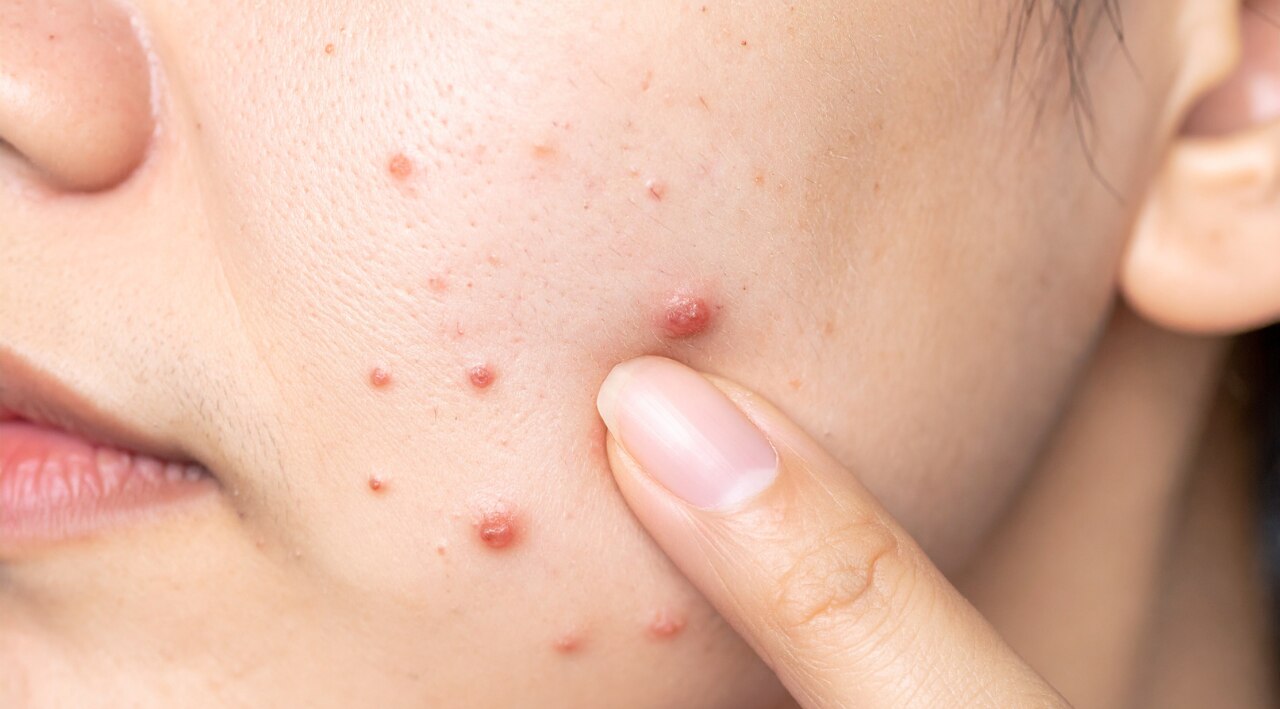 Acne Prevention: