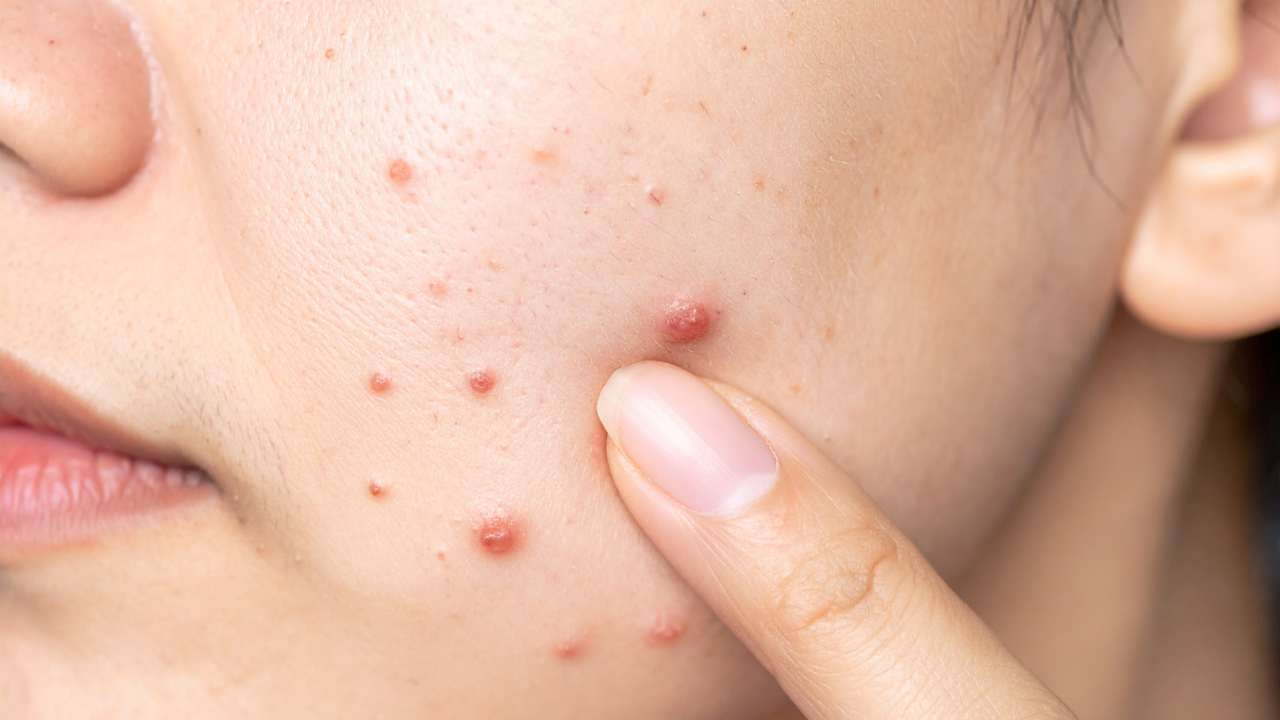 Acne Prevention: