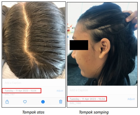 Foto kondisi rambut dan kulit kepala peserta di hari ke-1 sebelum keramas menggunakan produk CLEAR Fresh Cool Lemon Shampoo 300ml
