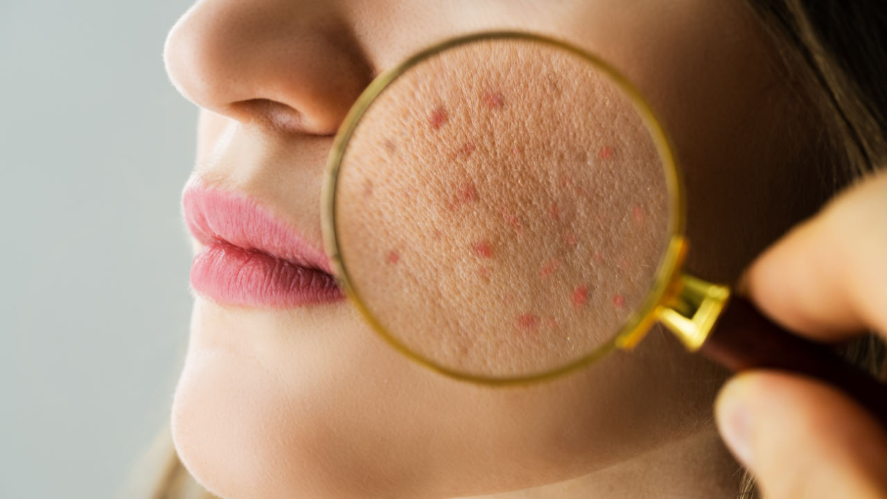 Oily and Acne-Prone Skin