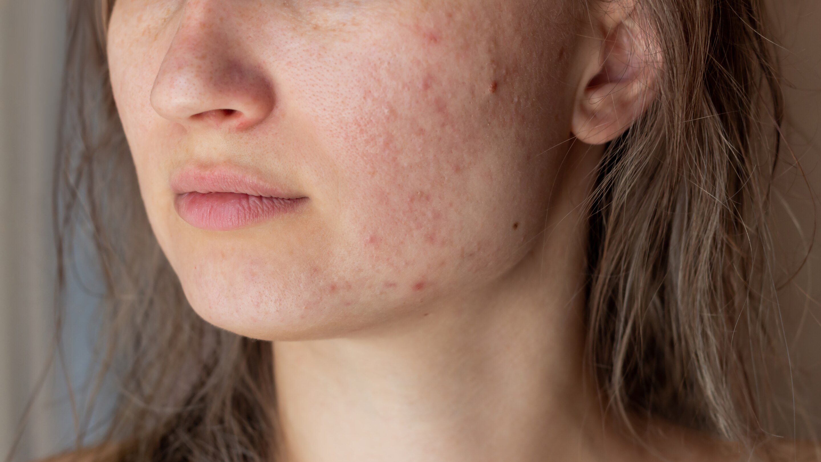 Possible Side Effects of Alpha Arbutin