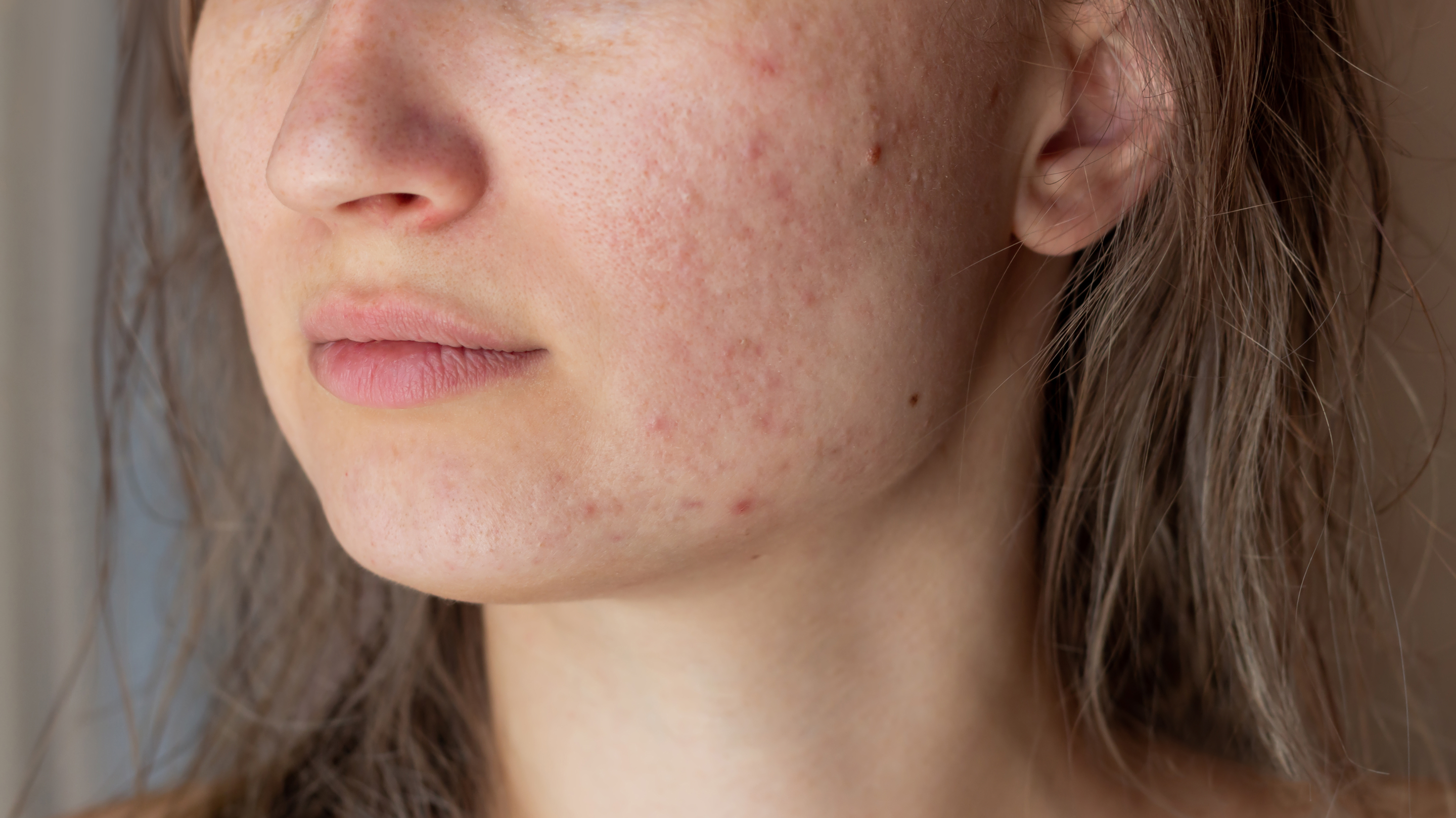 Possible Side Effects of Alpha Arbutin