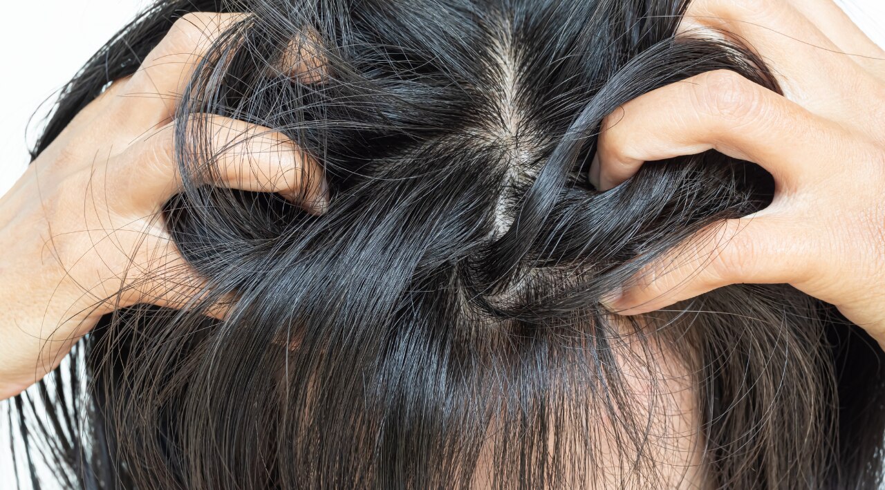 Dry, Flaky Scalp: