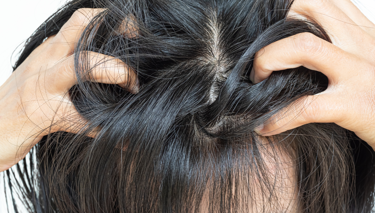 Dry, Flaky Scalp: