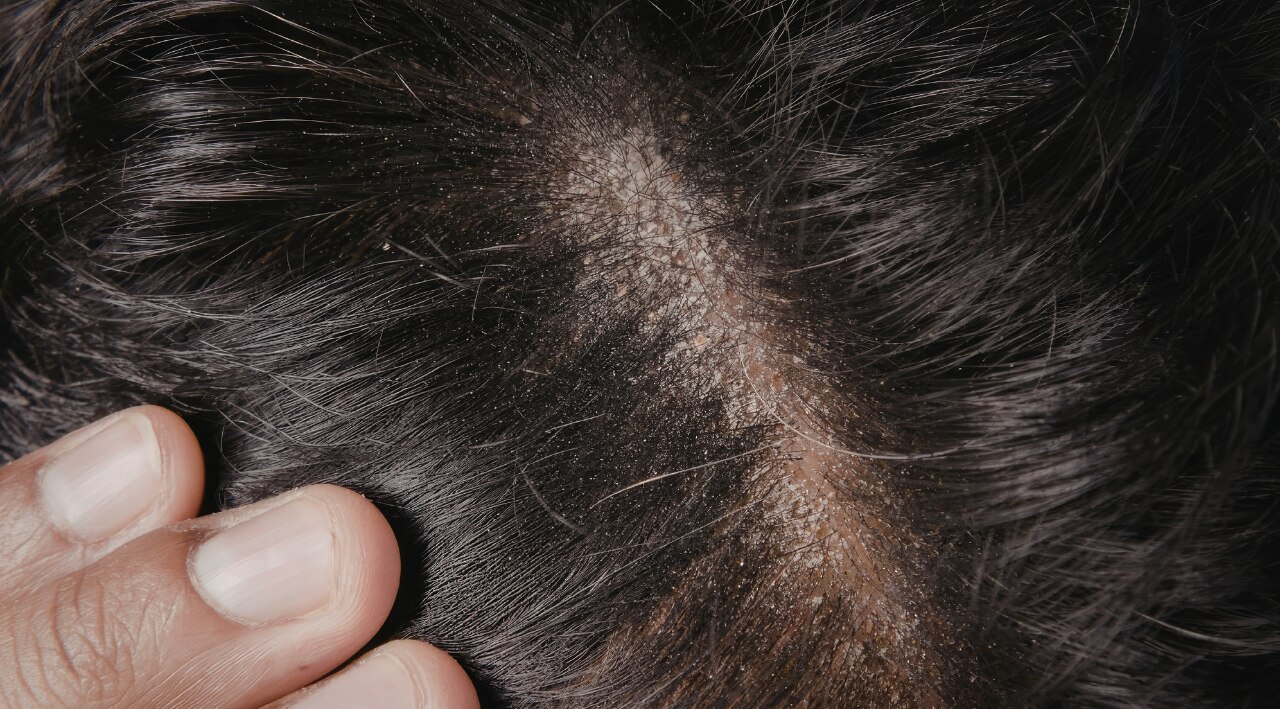 Oily Scalp: