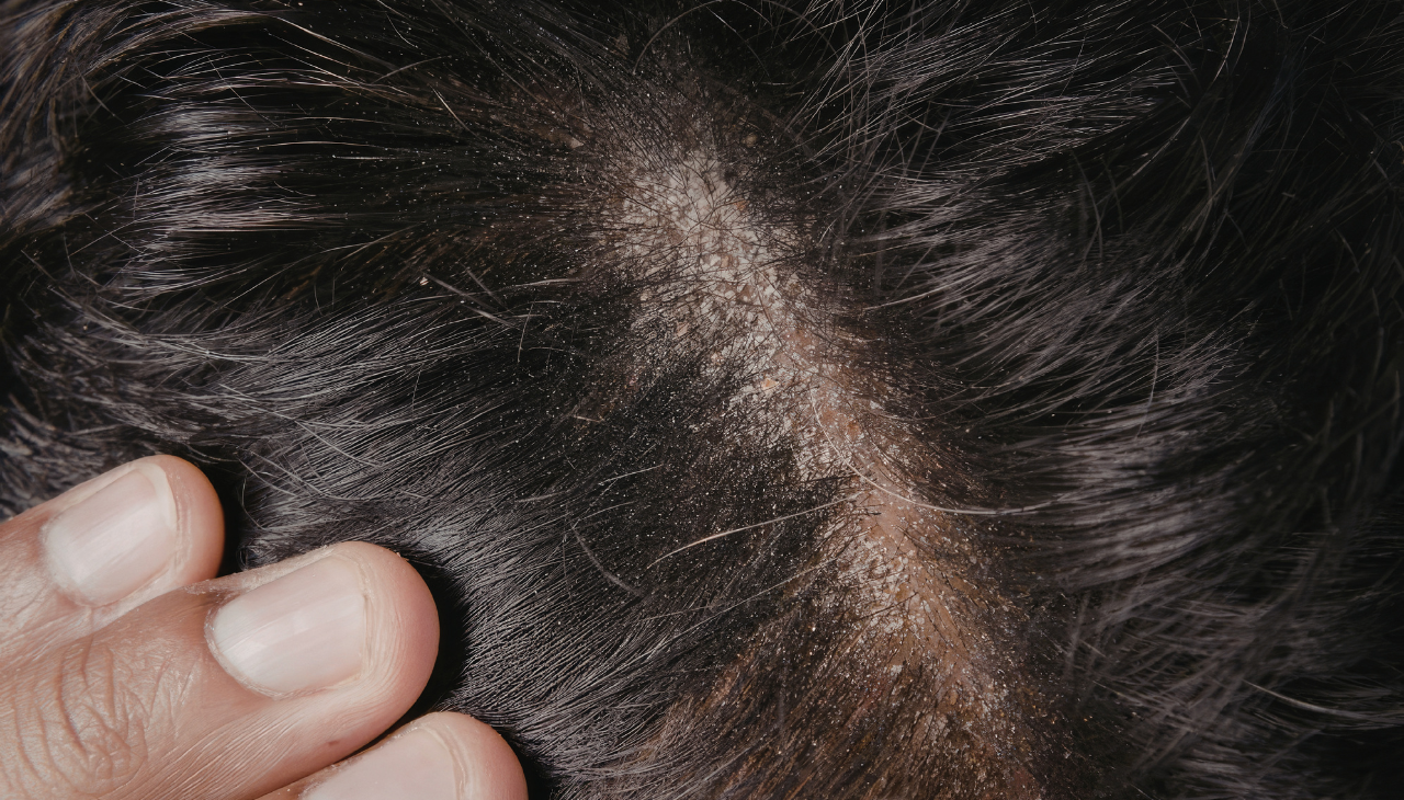Oily Scalp: