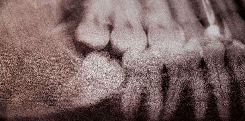  gigi bungsu tertutup gusi