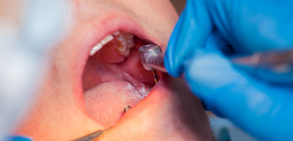 gigi geraham dicabut