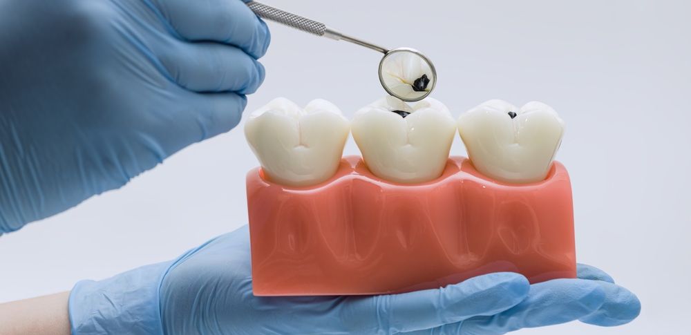 gigi geraham berlubang 