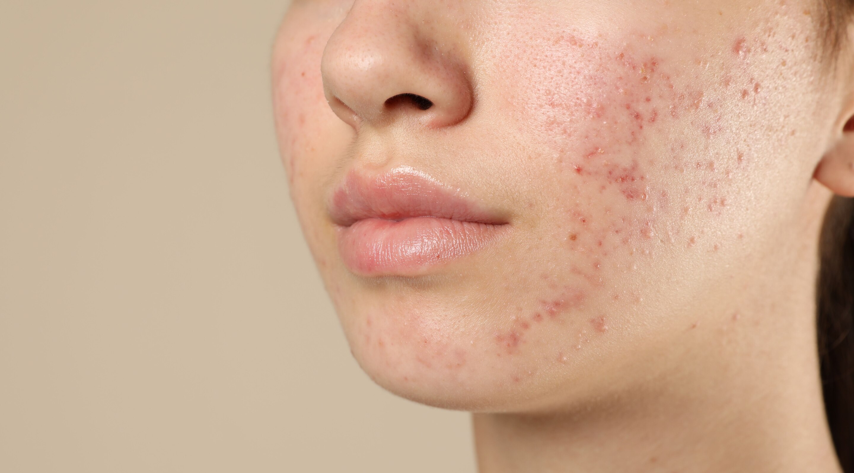 1. Acne Treatment