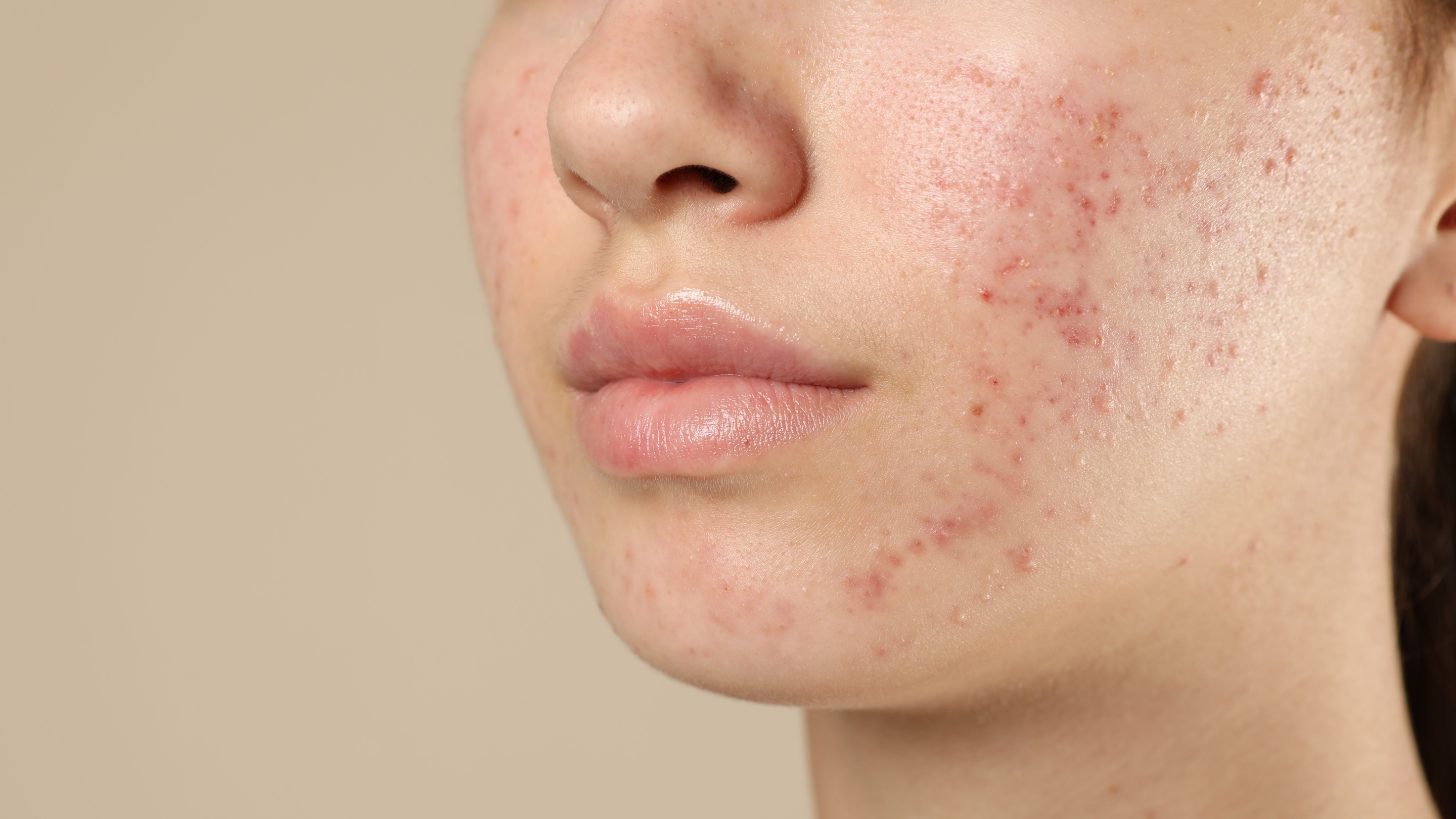 1. Acne Treatment