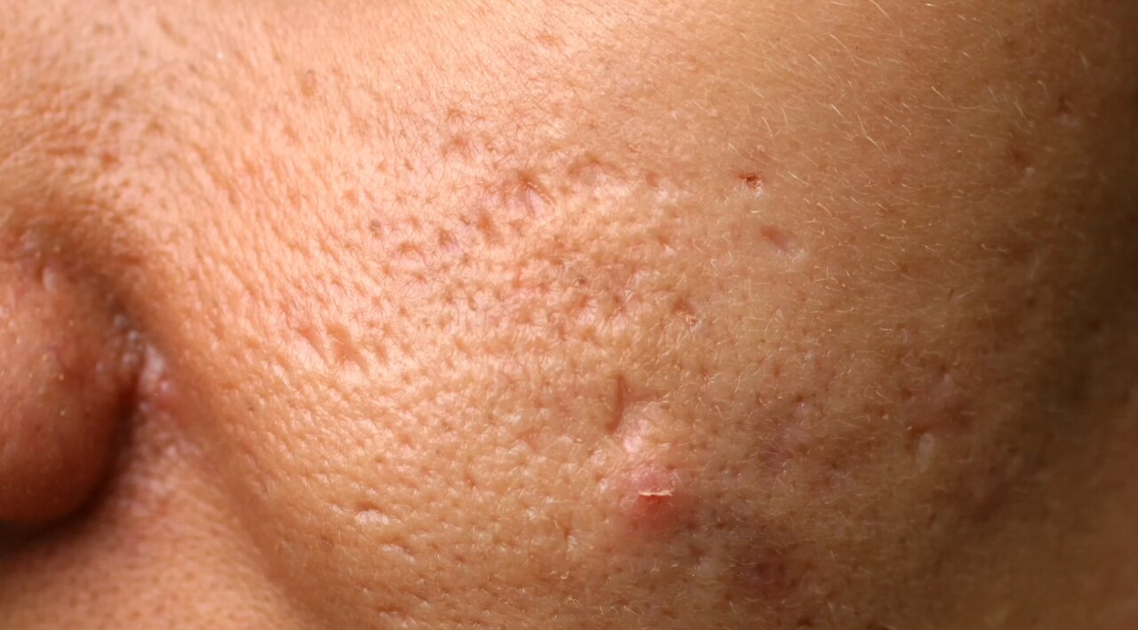 7. May Reduce Mild Inflammation