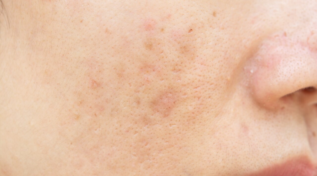 Helps Reduce Pigmentation Over Time: