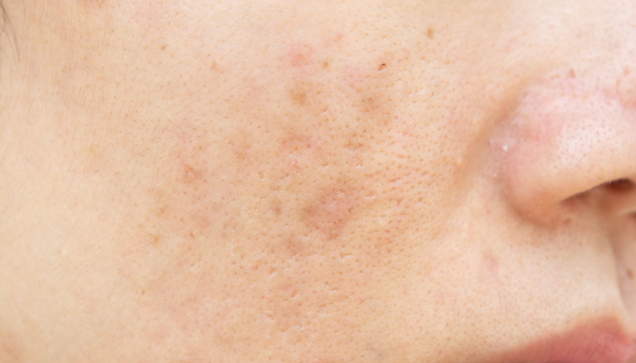Helps Reduce Pigmentation Over Time: