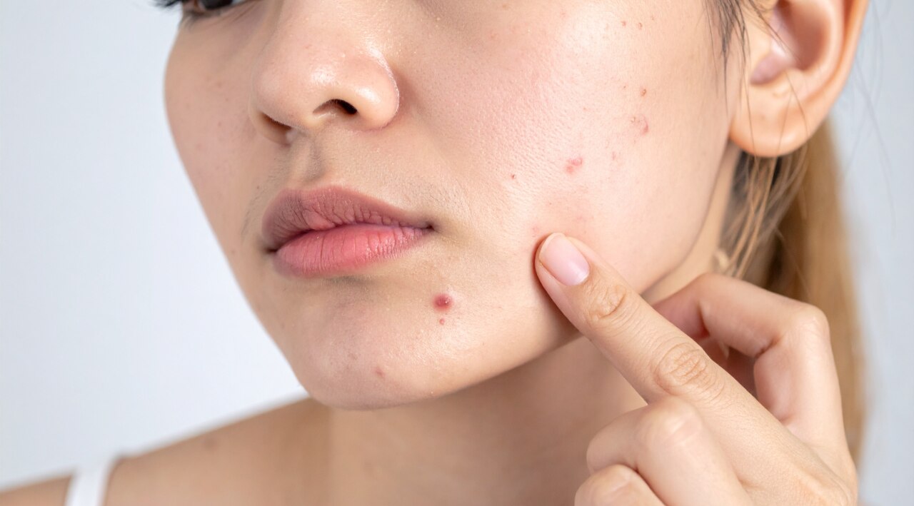 For Acne-Prone Skin