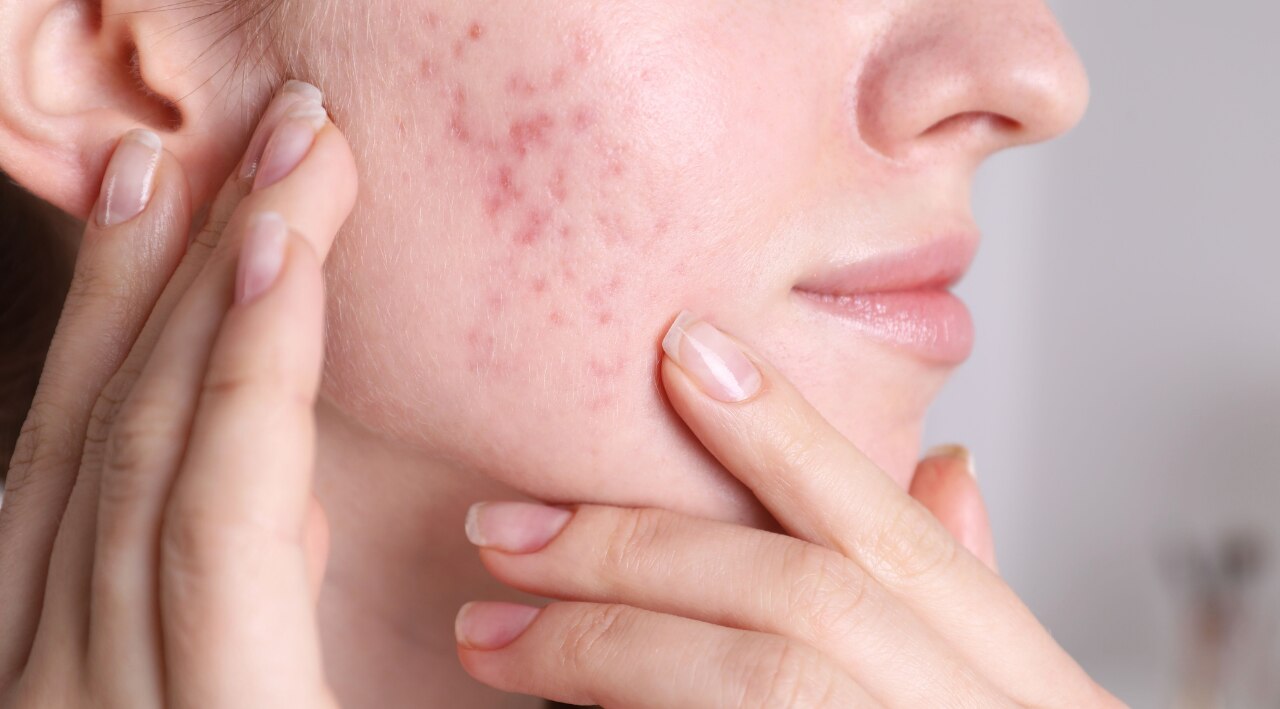 Retinol for Acne
