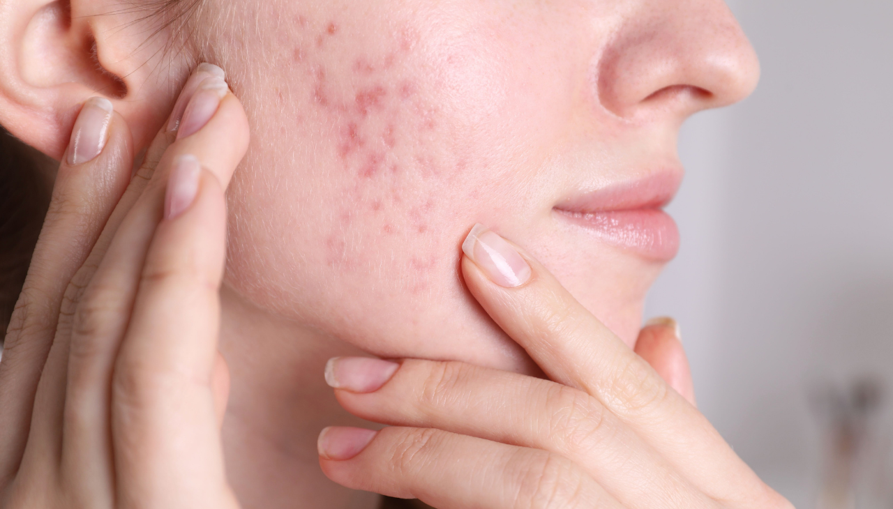 Retinol for Acne