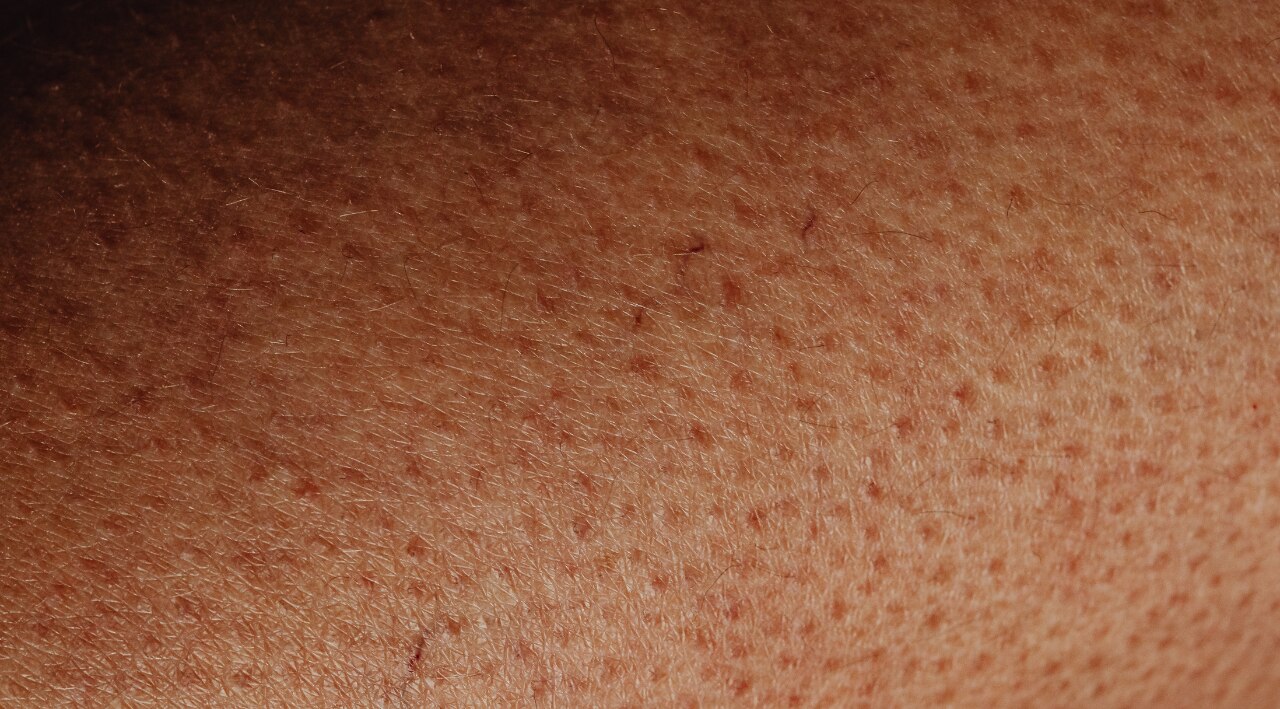 Retinol for Enlarged Pores