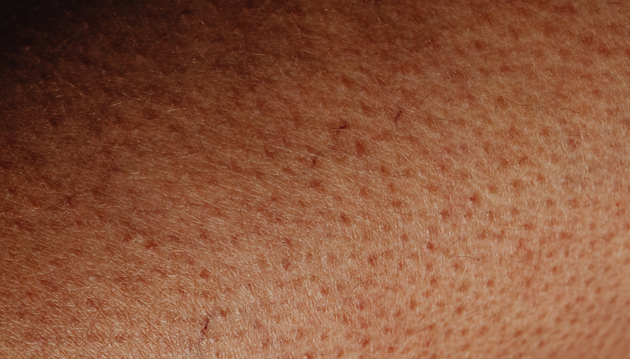 Retinol for Enlarged Pores