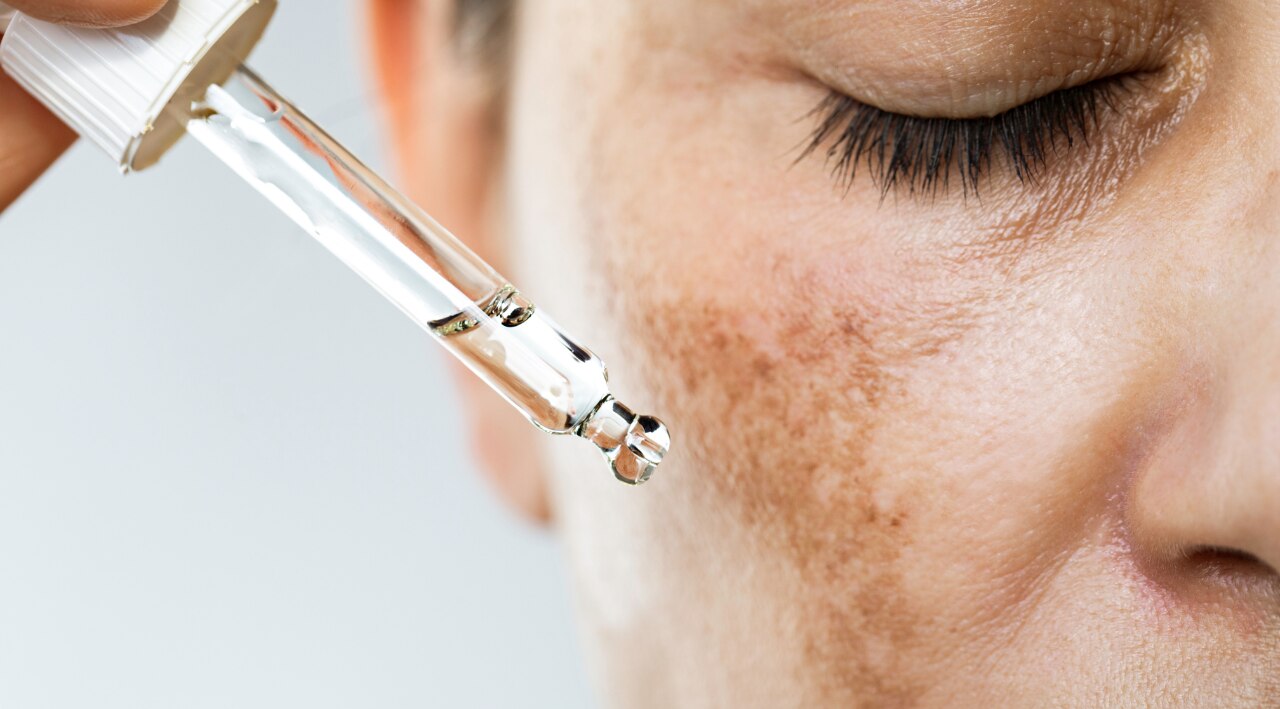 Retinol for Hyperpigmentation