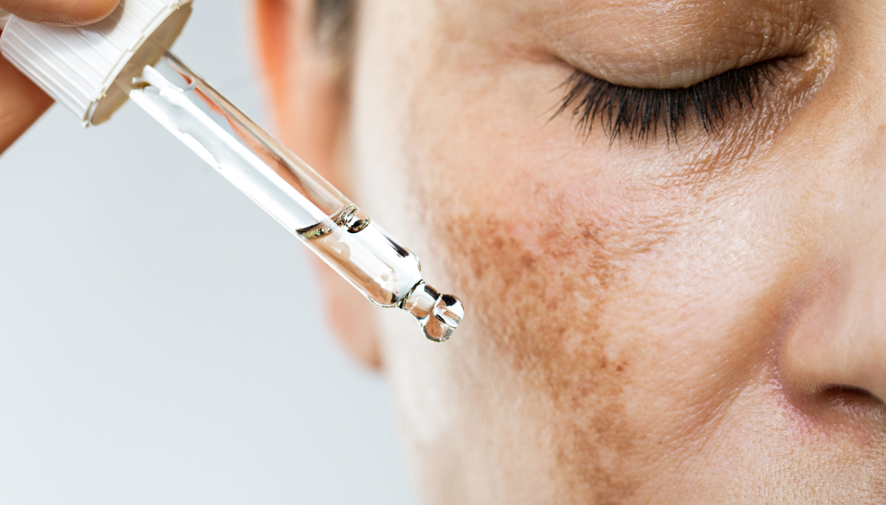 Retinol for Hyperpigmentation
