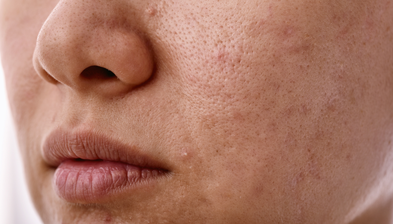 Retinol for Uneven Skin Texture