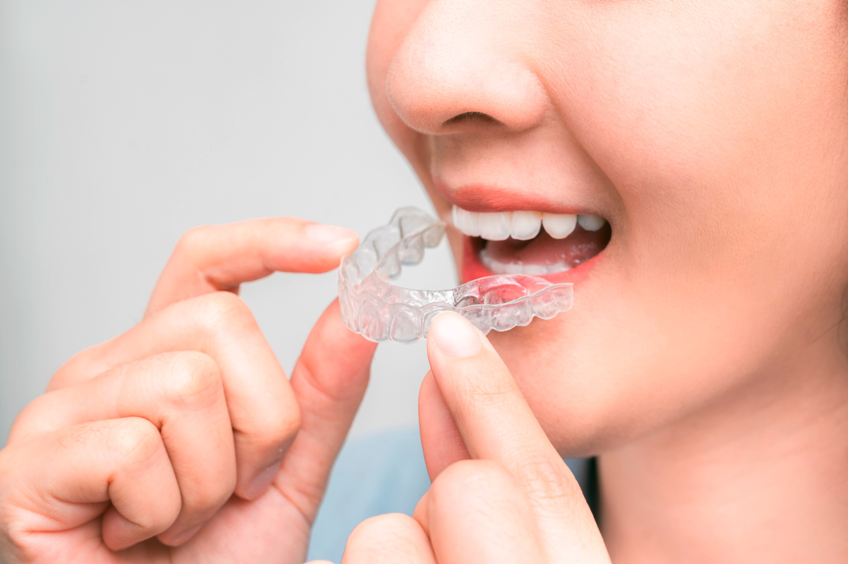  A woman with her clear aligners..