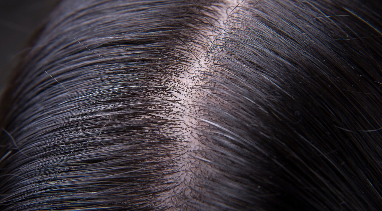 Improves Scalp Cleanliness