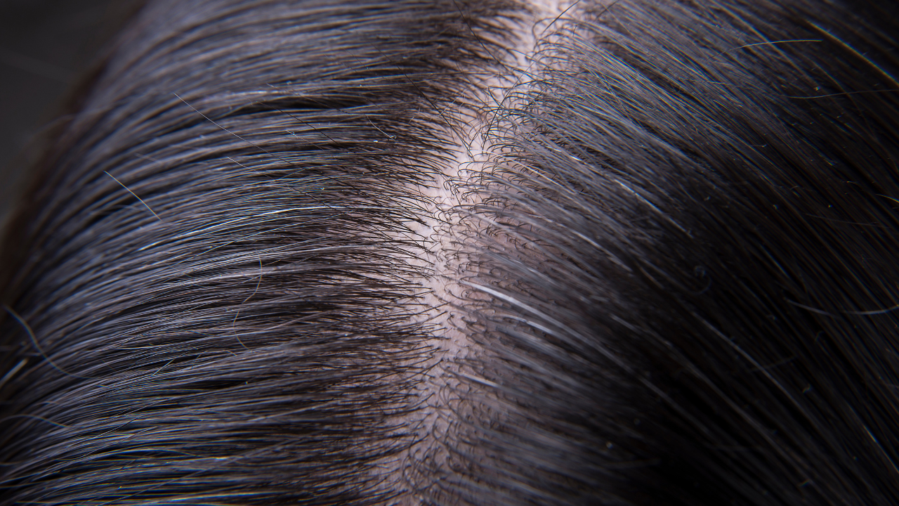 Improves Scalp Cleanliness