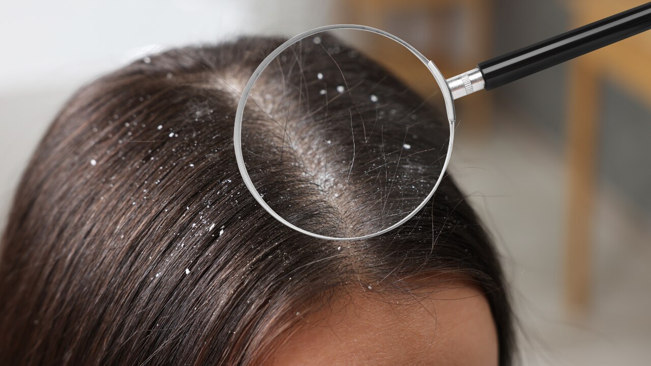 5. Treats  Dandruff: