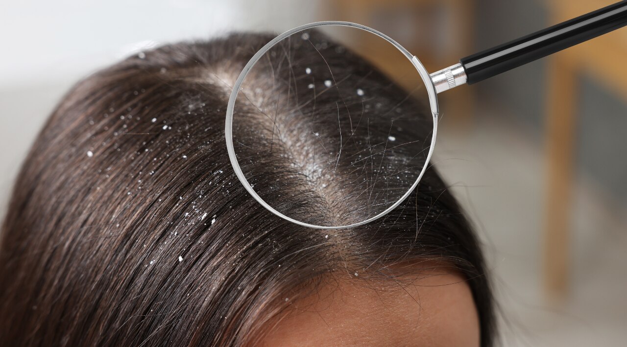 5. Treats  Dandruff:
