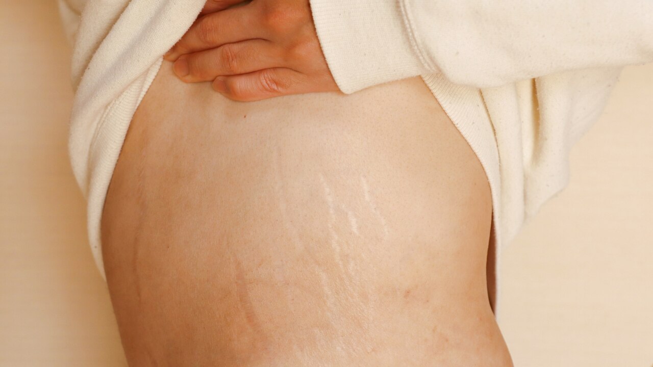 6. Minimizes Scars and Stretch Marks: