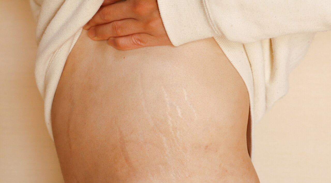 6. Minimizes Scars and Stretch Marks: